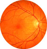 Retinal Vein Occlusion